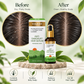 3% SALICYLIC ACID + 1% PIROCTONE OLAMINE ANTI DANDRUFF HAIR SERUM (30 ml)